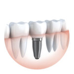 Dental implants sydney - Dr Paulo Pinho.jpg
