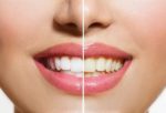 Teeth Whitening - Cure Dental.jpg